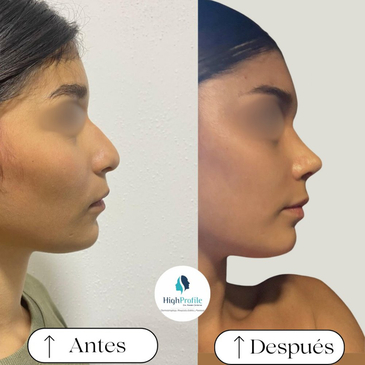 Slider image (6) Dra. Renata Cardenas-Aesthetic & Fuctional Rhinoplasty